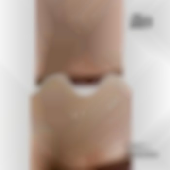 лазерная эпиляция