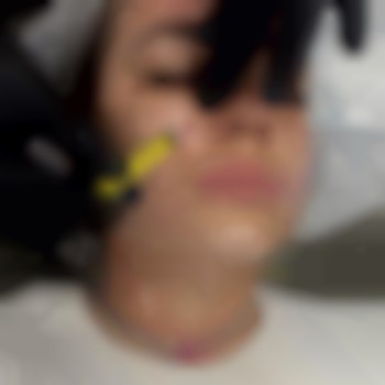 Мезотерапія обличчя,методикою наппаж з сироваткою освітлення