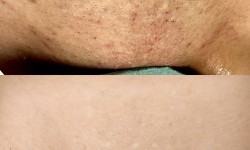 Лазерна епіляція бікіні, пахви, ноги повністю Мастер депиляции  Черкассы