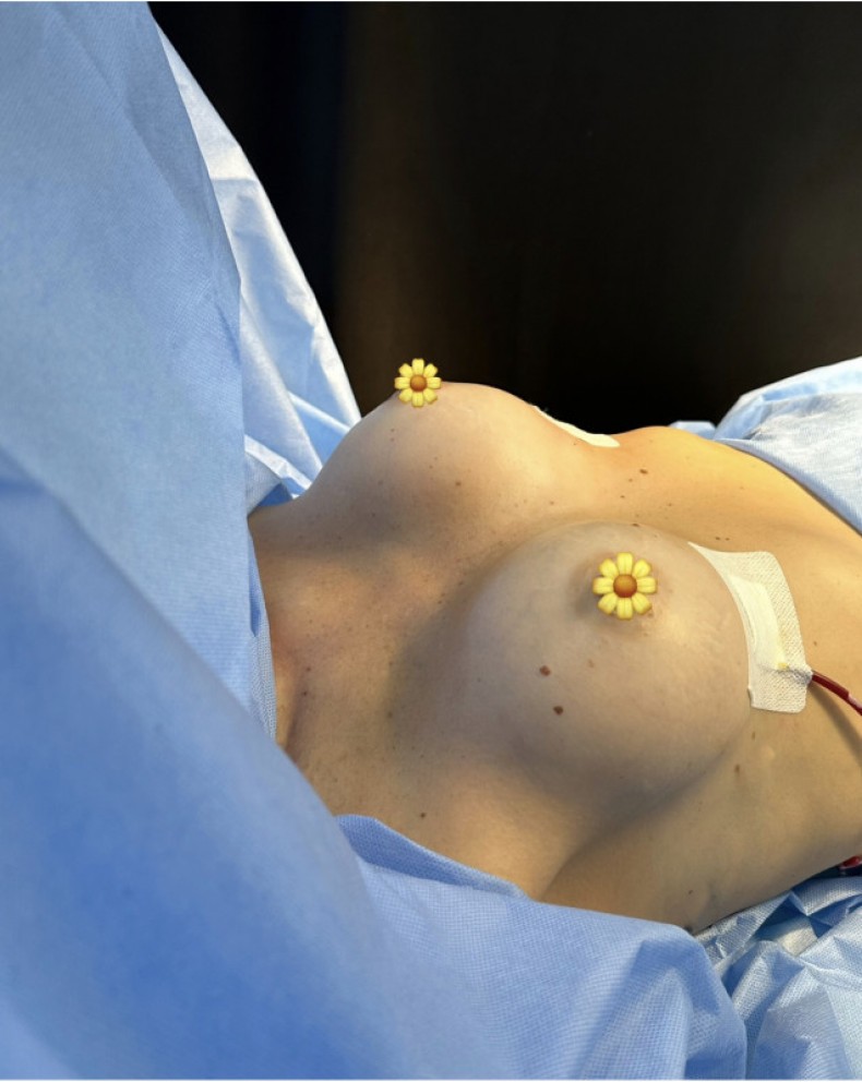 Мамопластика, фото - Клиника пластической хирургии Виста Пластика