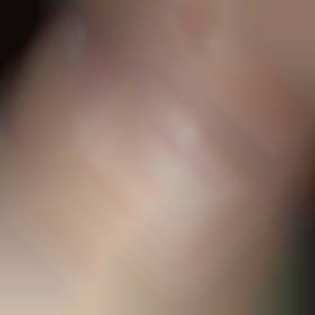 Результат 4х процедур (пахви)