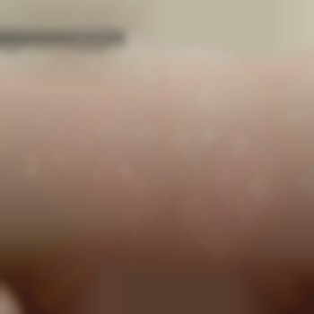 Результат 4х процедур (бікіні)