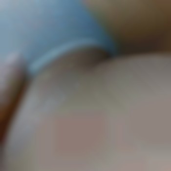 Электроэпиляция .Реакция кожи на уколы (так не у всех)