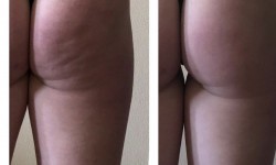 Антицелюлітний масаж Массажист  Киев