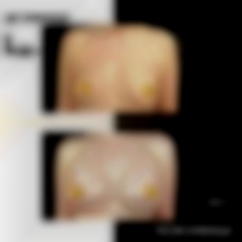 маммопластика, импланты в грудь