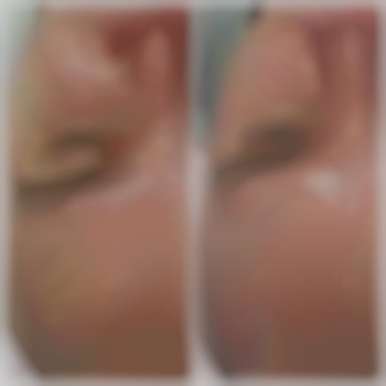 Ботокс+бланч-терапія