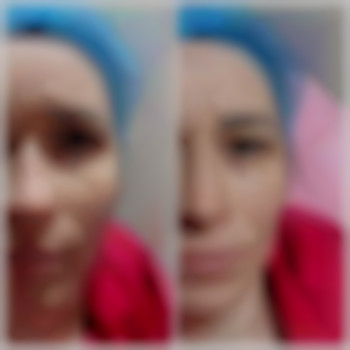 ПЛЛА
Полімолочна кислота