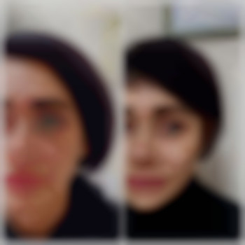 Контурна пластика