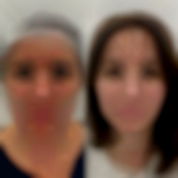 Біоревіталізація