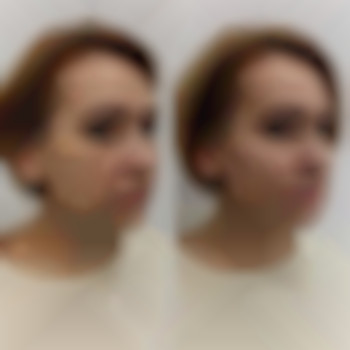 Контурна пластика