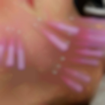 Тредліфтинг