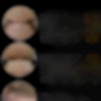 уколы ботокса для лица, коррекция морщин, уколы в лицо