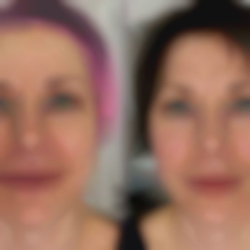 Біоревіталізація