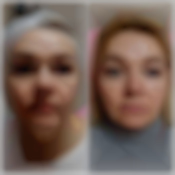 Контурна пластика