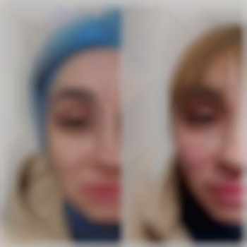 Контурна пластика