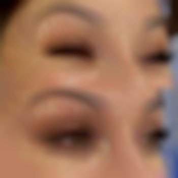 Ботокс нааколо очей