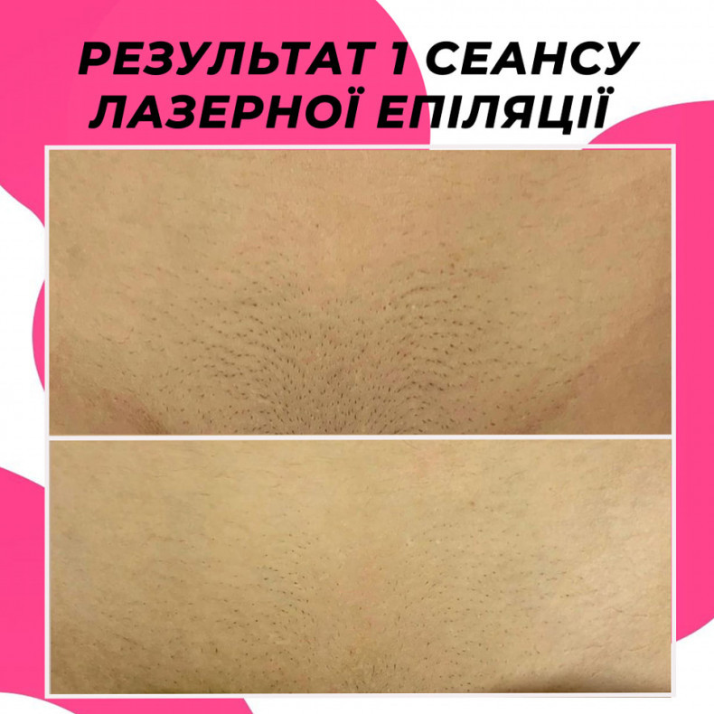 Лазерна епіляція зони глибокого бікіні, результат 1сеансу  #лазернаепіляція, фото - Салон красоты Мастерская Красоты "Юлии Юдиной"