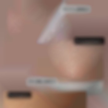 лазерная эпиляция бикини