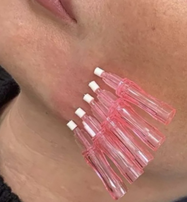 Фіксація зони бриль), фото - Косметолог Ирина Литвинова