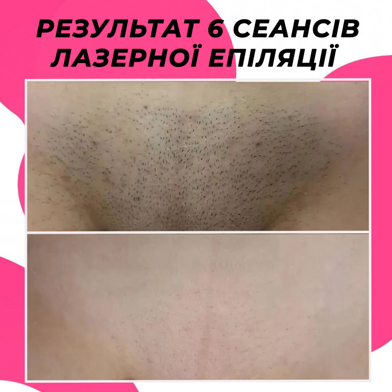Лазерна епіляція зони глибокого бікіні  #лазернаепіляція, фото - Салон красоты Мастерская Красоты "Юлии Юдиной"