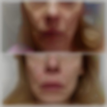 Корекція носогубних складок
 
 