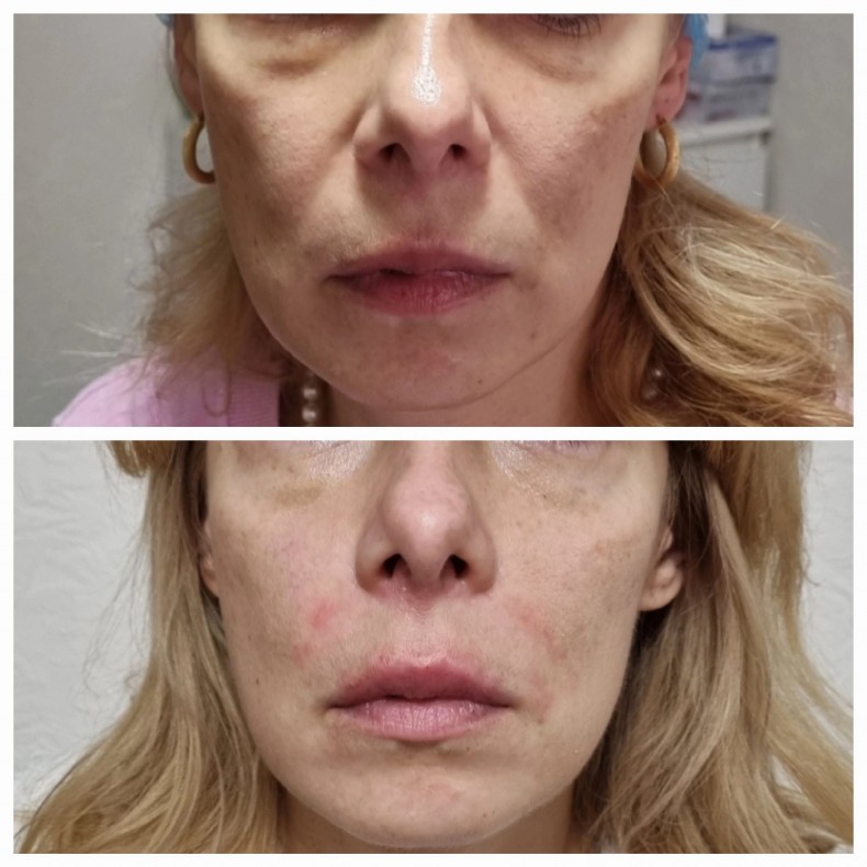 Корекція носогубних складок
 #носогубки
 #контурнаяпластика, фото - Врач-косметолог Лилия Николаевна