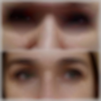 Корекція нососльозної борозди
 
 