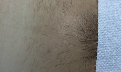 Електроепіляція бікіні Мастер депиляции Світлана Черкассы