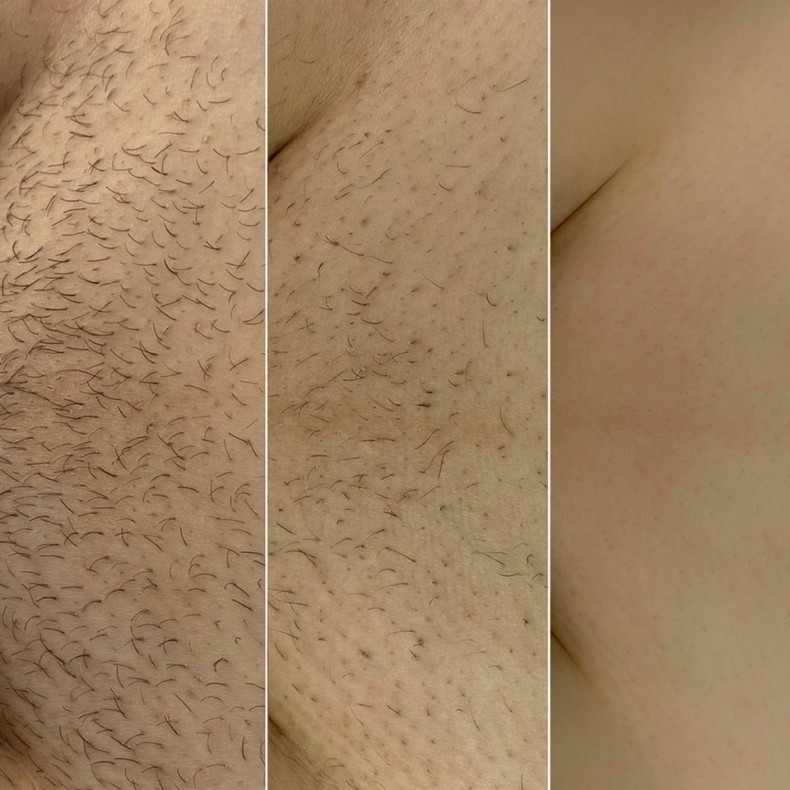 Прогрес під час курсу лазерної епіляції: різниця між 1, 3 та 8 сеансами.  #лазернаепіляція, фото - Салон красоты Мастерская Красоты "Юлии Юдиной"