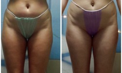 Антицелюлітний масаж Массажист Юлія Тернополь