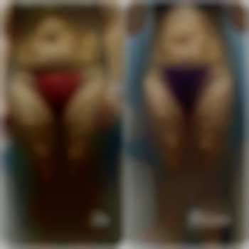 Антицелюлітний масаж
                    Массажист Юлія Тернополь