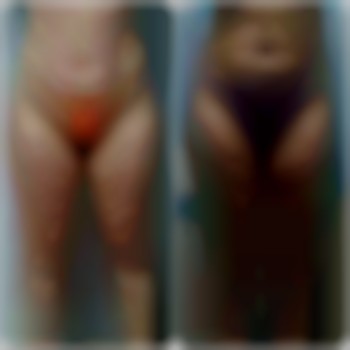 Антицелюлітний масаж
                    Массажист Юлія Тернополь