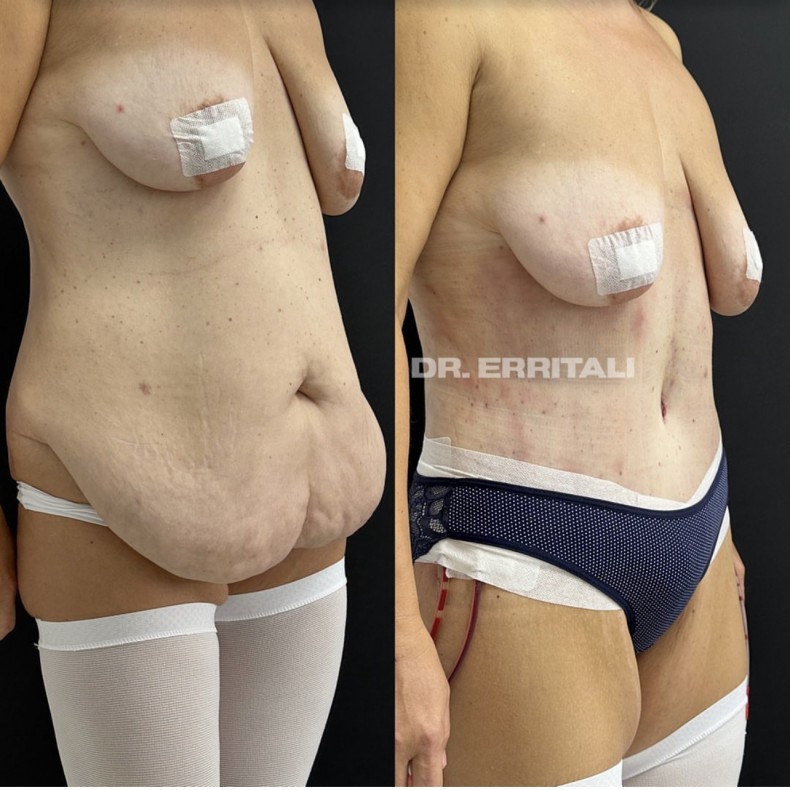 Бодилифт с липосакцией, фото - Пластический хирург Абдель Эрритали