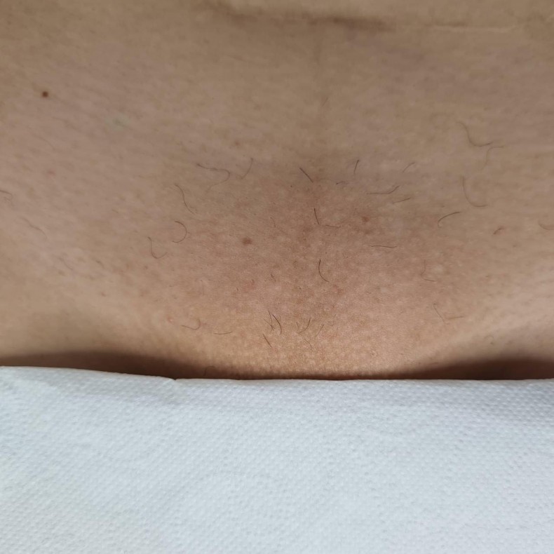 Результат курсу лазерної епіляції бікіні  #лазернаепіляція #лазернаепіляціякиїв #лазернаепіляціябікіні, фото - Салон красоты Мастерская Красоты "Юлии Юдиной"