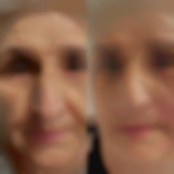 Липофиллинг