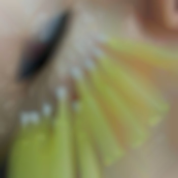 Нитевой лифтинг