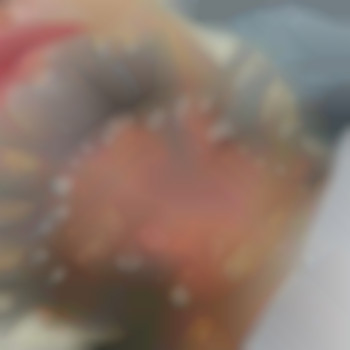 Работа по овалу мезонитями