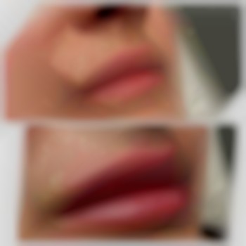 Увеличение губ