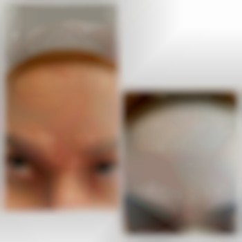 Ботокс до и после