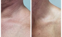 RF ліфтинг Врач-косметолог Лилия Киев