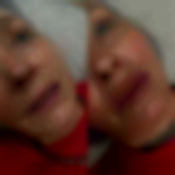 Возрастные губки, обожаю с ними работать, потому что перевоплощение невероятно 😍
Препарат: Stylage M 1ml
⏰Время 40мин
💵4500грн, фото - стоматолог Диана Скоркина