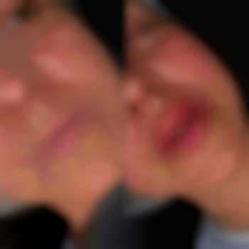 Первичное увеличение 👄
Препарат: Stylage M 1ml
⏰Время 40мин 
💵 4500грн, фото - стоматолог Диана Скоркина