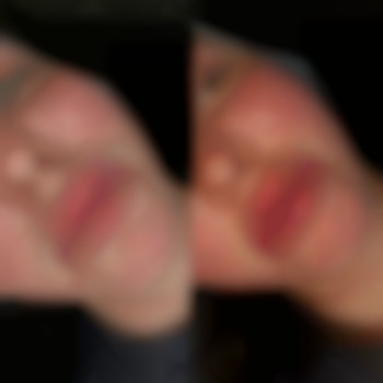 Девушка уже до этого делала губы у другого косметолога (в губах 1ml), мы добавили еще 1ml 💉
Исправили асимметрию и прибавили рыхлость👄
Препарат: Alexa Volume 1ml
⏰Время 40мин
💵 3500грн, фото - стоматолог Диана Скоркина