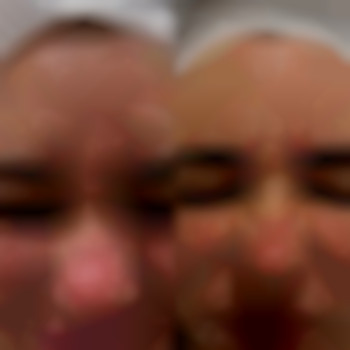 Ботулинотерапия зоны:
Лоб+межбровье+глаза+кроличьи морщины.
Итог на 14 день👌🏻
‼️Далее уже нужно прорабатывать статические морщины, которые Ботулотоксин не разгладил филлером в технике БЛАНШИНГ💫, фото - стоматолог Диана Скоркина