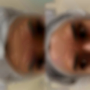 Ботулинотерапия зоны:
Лоб+межбровье+глаза+кроличьи морщины.
Итог на 14 день👌🏻
‼️Далее уже нужно прорабатывать статические морщины, которые Ботулотоксин не разгладил филлером в технике БЛАНШИНГ💫, фото - стоматолог Диана Скоркина