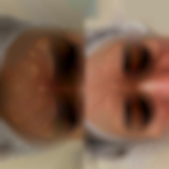 Ботулинотерапия зоны:
Лоб+межбровье+глаза+кроличьи морщины.
Итог на 14 день👌🏻
‼️Далее уже нужно прорабатывать статические морщины, которые Ботулотоксин не разгладил филлером в технике БЛАНШИНГ💫, фото - стоматолог Диана Скоркина