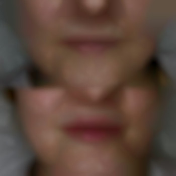 Деликатная коррекция маленьких губ 👄
Препарат: Alexa Medium 1ml
⏰Время 40мин
💵 3500грн, фото - стоматолог Диана Скоркина