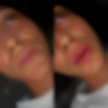 Первичное увеличение губ🌸
Препарат: Stylage M (без лидо) 1мл
Процедура была проведена под инфильтрационной анестезией 💉
Период реабилитации: от 10-14 дней 
Цена: 4500грн + 150грн стомат анестезия., фото - стоматолог Диана Скоркина