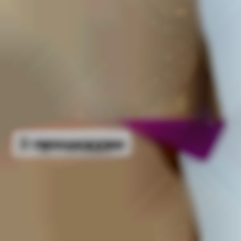 Результат після 2-х процедур,до було подразнення після гоління,вросле волосся, щоденне гоління