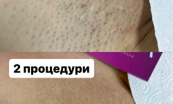 Лазерна епіляція Мастер лазерной эпиляции Ануш Чернигов